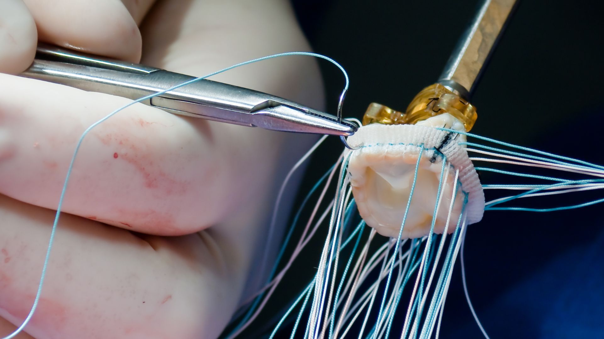 An artificial heart valve, an EU Class III Medical Device