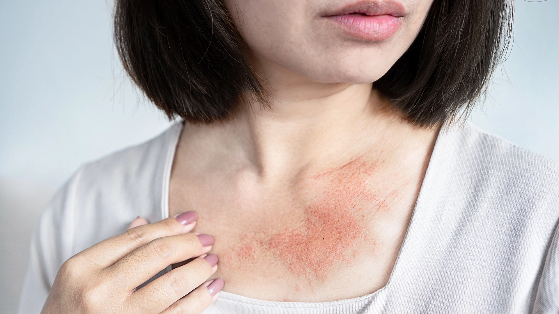 large rash visible on woman's neck from allergic reaction to perfume